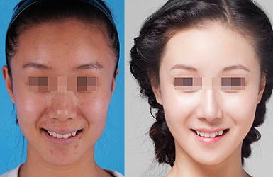 熱拉提的治療效果好不好？多久起效？